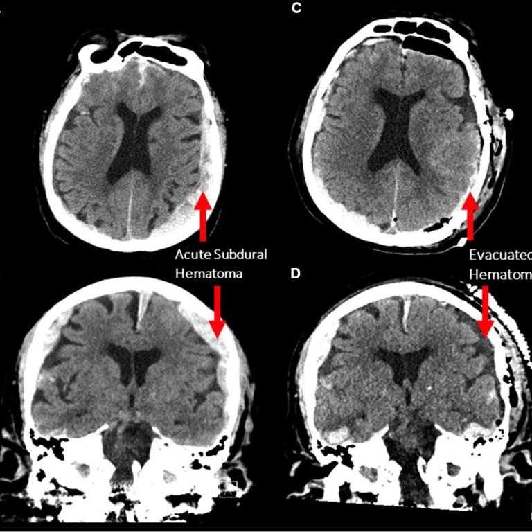 The study accidentally found flashes in the brain that could suggest we relive memories when we die. Picture: Frontiers in Ageing Neuroscience