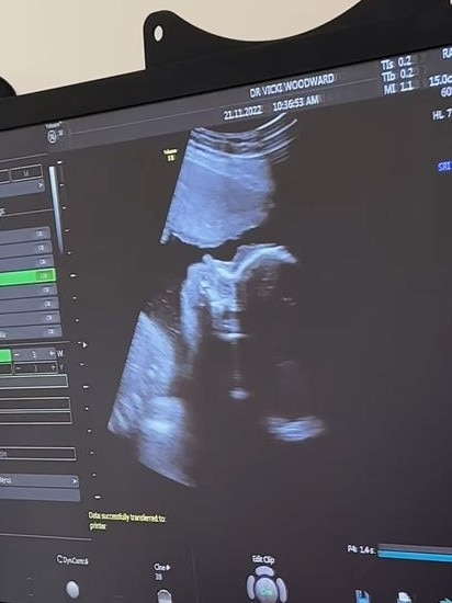 The couple shared a photo of the sonogram. Picture: Instagram/Martha Kalifatidis