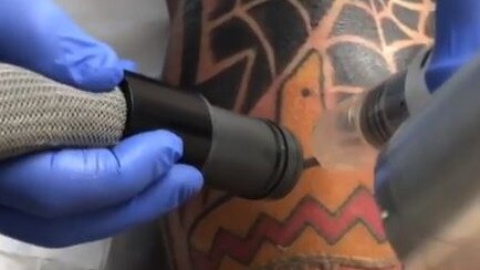 Mitchell posted a photo of his tattoo removal on social media. Picture: Instagram