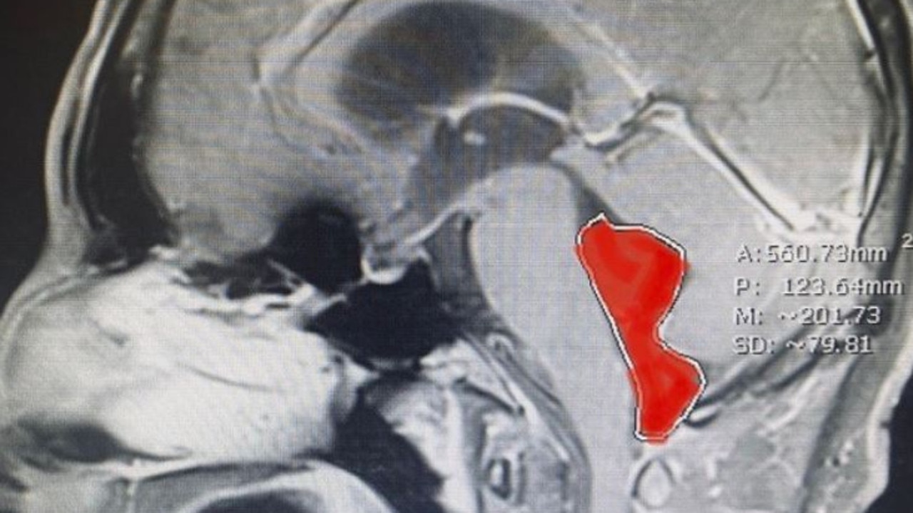 Texas Doctors Discover ‘rare Tapeworm In Mans Brain From Undercooked Pork Au 0946