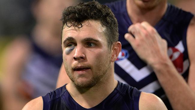 AFL — Round 17, Fremantle Dockers vs Geelong Cats at Subiaco Oval, Perth. Photo by Daniel Wilkins. PICTURED- Fremantle's Hayden Ballantyne sporting a decent black eye after copping a boot in the face during the second term