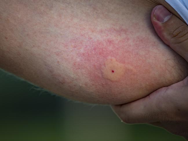 People can react differently to mosquito saliva, especially children and newcomers into the country who don’t have immunity or tolerance to mosquito bites. Picture: iStock