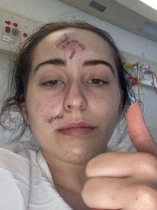 Ms Owens had to get plastic surgery and needed 28 stitches. Picture: Supplied