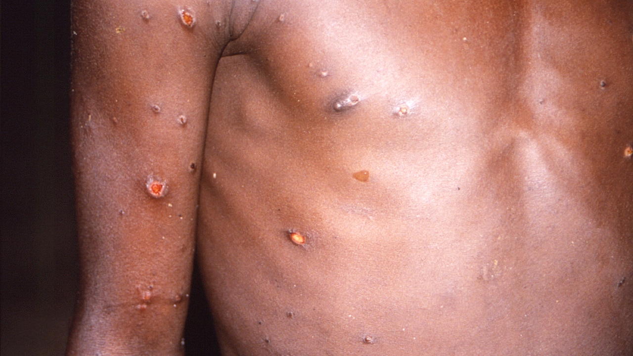 Monkeypox can be contained: WHO