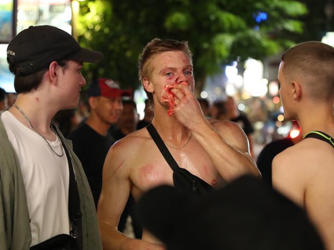 This young man was left nursing a bloody nose. Picture: Liam Kidston