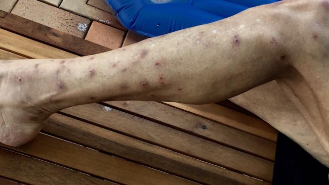 Last year a Helensvale woman was diagnosed with Ross River virus and could no longer leave her home due to the number of mosquito bites.