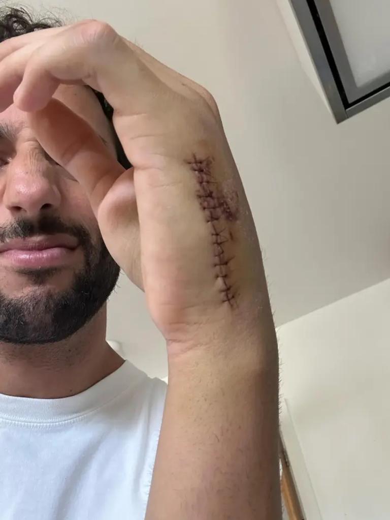 Daniel Ricciardo shows his post-surgery scars. Photo: Instagram