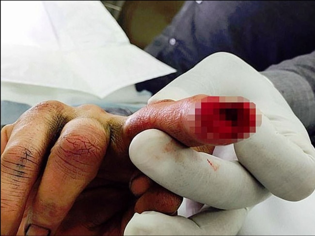 A close-up of Johnny Depp’s severed finger. Picture: Supplied