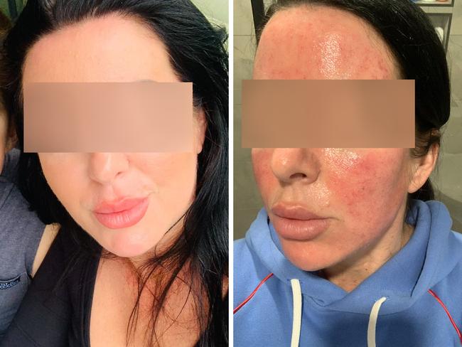 Sarah's skin needling turned into a horrific nightmare as the alarm is sounded over a lack of regulation in Australia. Picture: Supplied