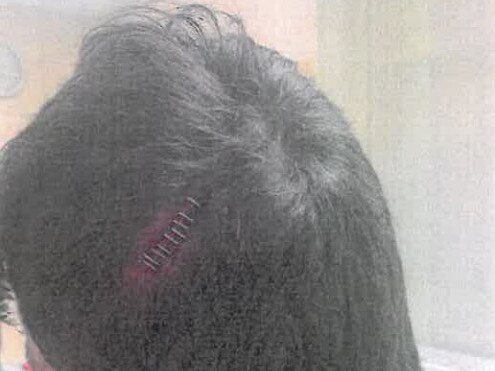 The victim after receiving nine staples following the brutal attack by Braedyn Parker