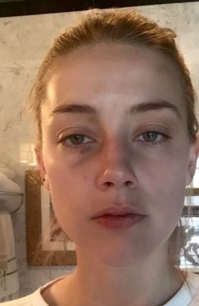 This photo of Amber Heard was discussed in court, showing injuries said to have been sustained during an incident involving Johnny Depp. He has denied the allegations.