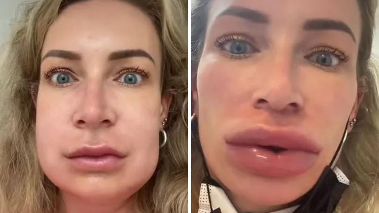 A woman has revealed the disastrous outcome of her decision to get lip filler. Picture: TikTok