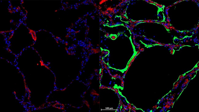 On the left is a healthy control lung, wihile on the right is post mortem lung tissue from soemone who died from Covid - with teh newly disocered LRRC15 receptor shown in green. Picture: Loo and Waller et al