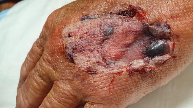 Gary Ward underwent a skin graft on his left hand following the attack. Picture: Meg Ward