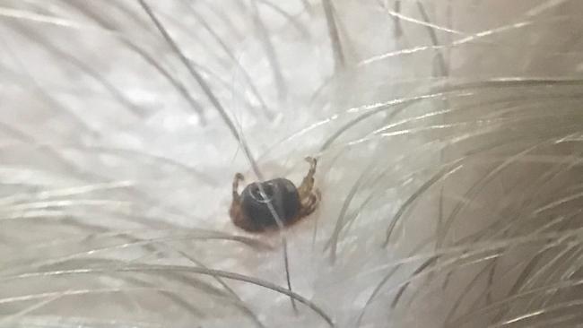 An example of a tick embedded in somebody’s head.