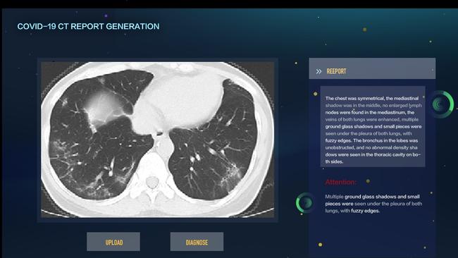 Artificial intelligence offers an almost instant diagnosis of COVID-19 based on a CT scan. Picture: Monash University.