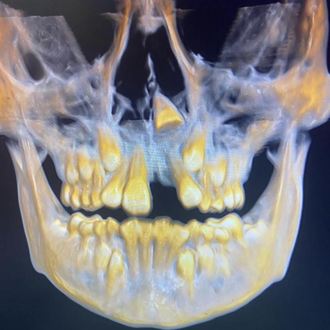 X-rays reveal the horrific damage to Rylie’s teeth. Picture: Supplied to Daily Mercury