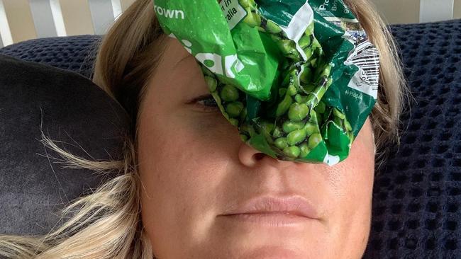 Grafton media star Katie Brown gives her broken nose the old fashioned bag of peas after her debut for the South Sydney Rabbitohs NRLW side back in July.