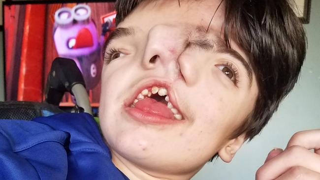 Tres Johnson wasn’t expected to live after being born with a rare condition called ‘craniofacial duplication’. Picture: Brandy Johnson/Caters News