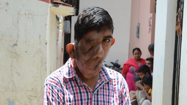 Bhupinder Singh lives virtually as a recluse after he was shunned from school because of his unusual appearance. Picture: Caters