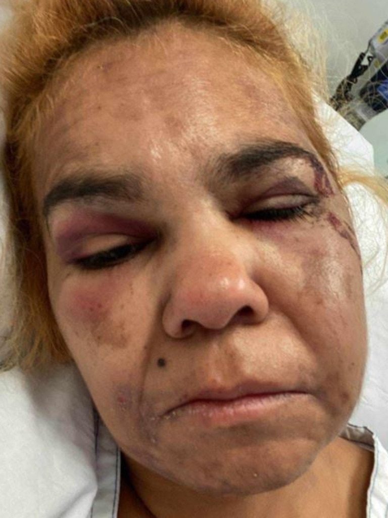 Irene McHugh in hospital after being assaulted.