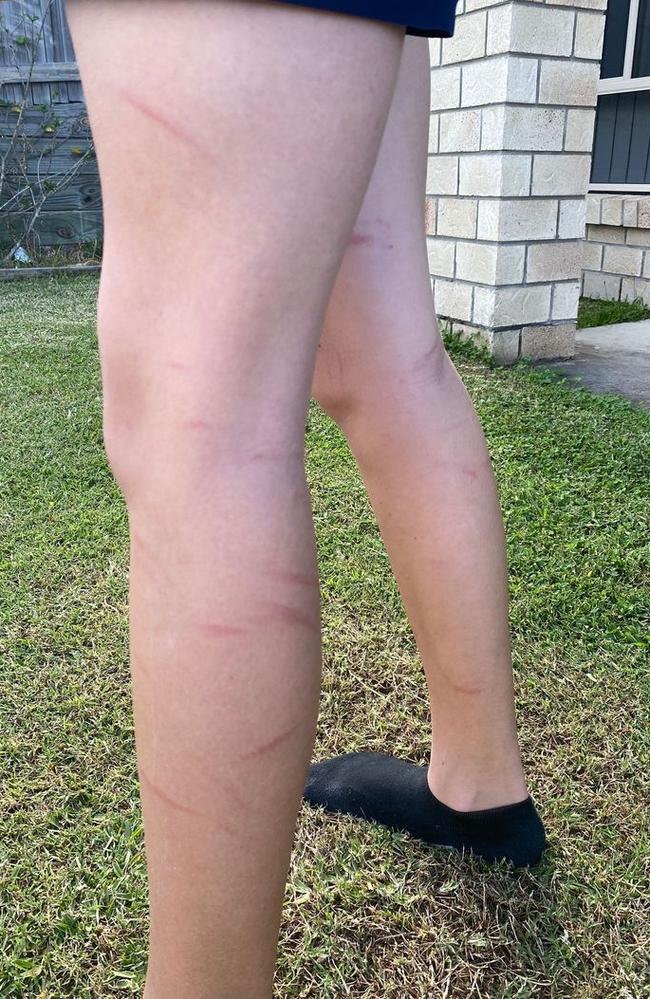 12-year-old girls 'whipped' legs after a day at Flagstone State Community College. Picture – contributed.