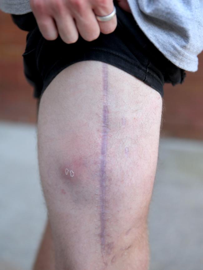 Samuel Lethbridge massive scar on his leg after he was pinned under the dash of his car. Picture: Nathan Edwards