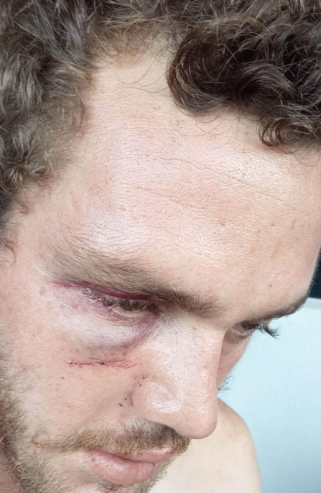 Millner resident Jayden Kearney has reportedly suffered an eye socket fracture, jaw fracture, chipped teeth and split lips as a result of a road rage attack at Coolalinga. Picture: Supplied