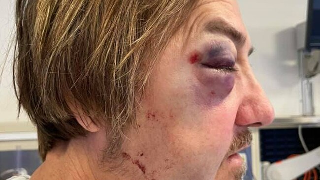 Gary Haslett will have to undergo surgery after his cheek bone was fractured during the incident.