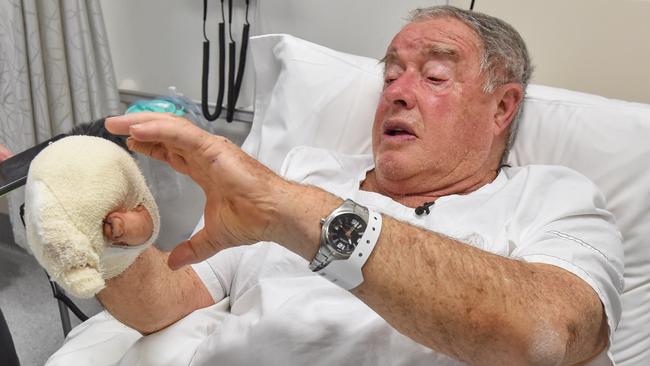 Shark attack victim, Rodney McFarlane meets the media at the Alfred Hospital. Picture: Tony Gough