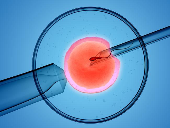 3D rendering of the icsi(intracytoplasmic sperm injection) process - in which a single sperm is injected directly into an egg  Picture: Istock