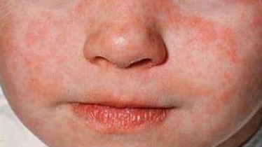 A child with measles. Pic: NSW Health