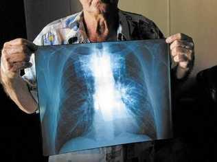 BLACK LUNG: The Queensland State Government have started a register for dust lung diseases. Picture: Contributed