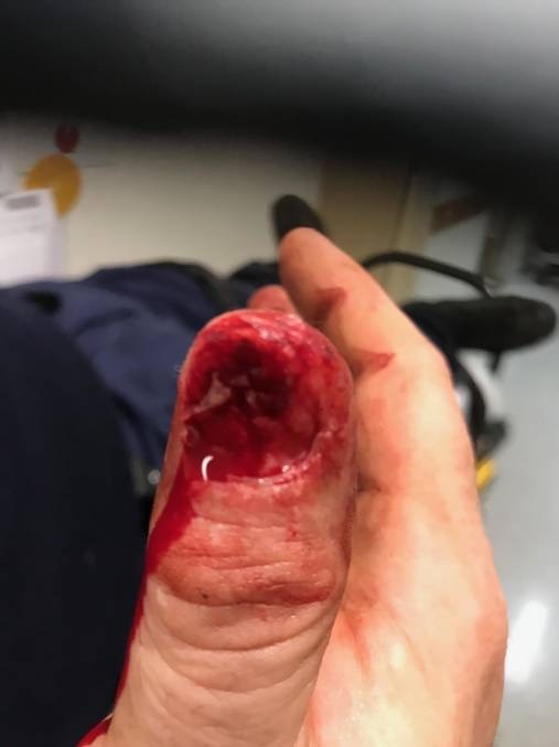 A police officer's thumb after he was attacked by Marty Edwards. Picture: NSW Police