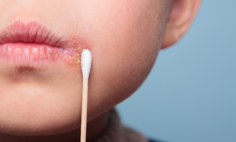 Cold sores clearance in toddlers