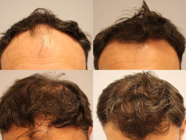 Mark’s hairline before and then six months after his transplant.