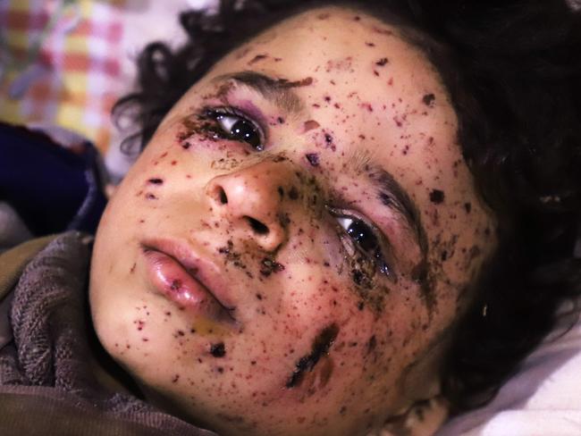 TOPSHOT - Ten-year-old Omar who was injured in an air strike, that killed several members of his family, on their home in Otaybah receives treatment at a make-shift hospital in Syria's rebel-held enclave of Eastern Ghouta, on February 25, 2018.  / AFP PHOTO / AMER ALMOHIBANY