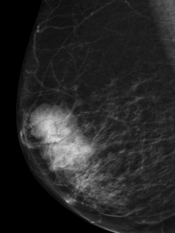 Mammogram image that shows breast cancer. Picture: Supplied