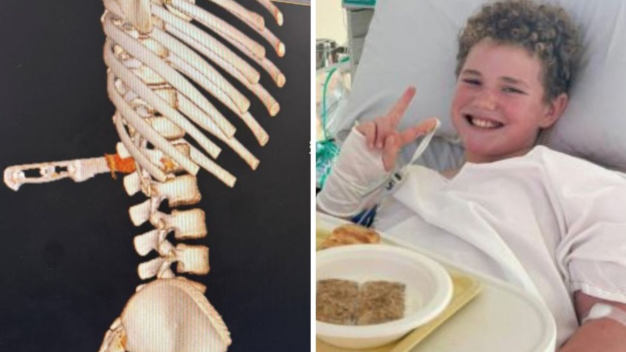 10yo impaled in freak cheese toastie accident