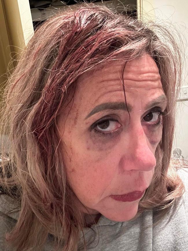 Caitlin Morrison, 45, was assaulted on a Melbourne tram on April 22. Picture: Supplied