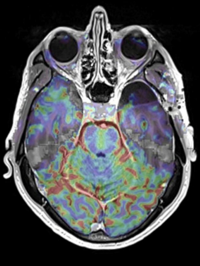 Professor Richard Scolyer has gone eight months without seeing the return of his glioblastoma. Picture: Supplied