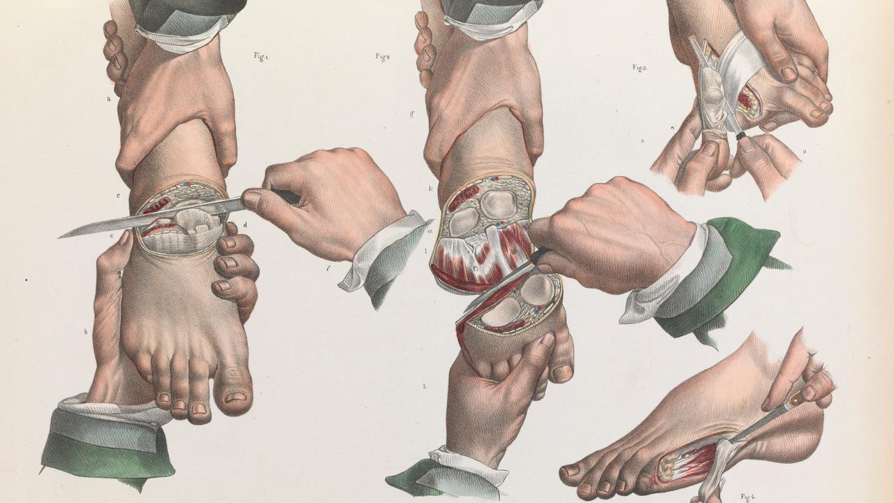 Amputations of the toes and foot. Picture: Wellcome Collection.