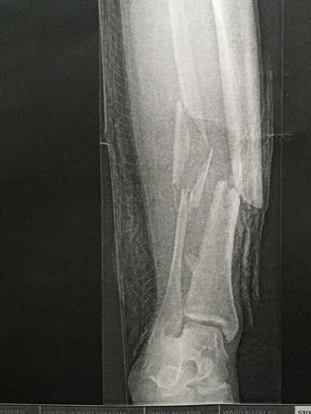 An x-ray of Jake Stone’s leg after the accident.