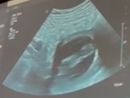 Uati "Pele" Faletolu's girlfriend Taylor Piliae’s ultrasound.