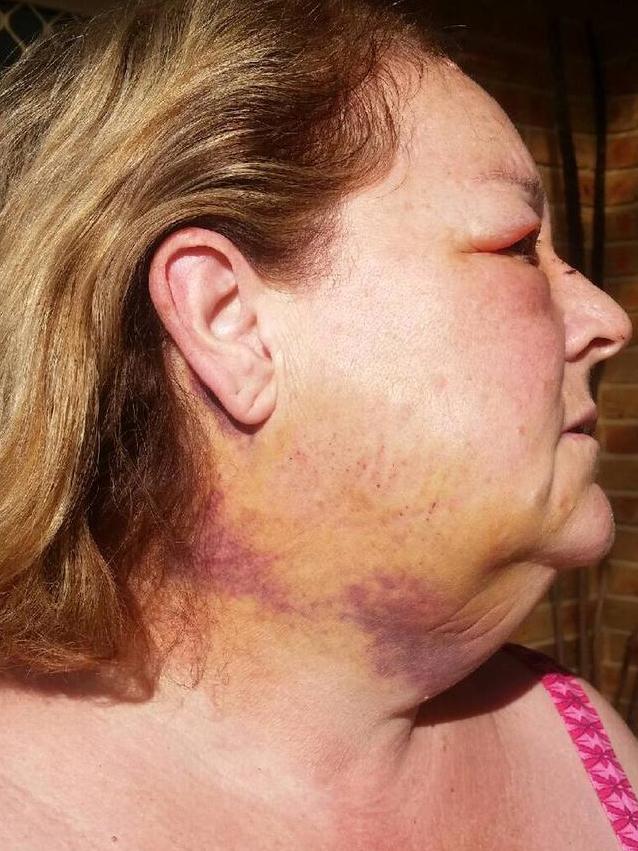 Bruising to Linda’s neck from the accident. Picture: Supplied