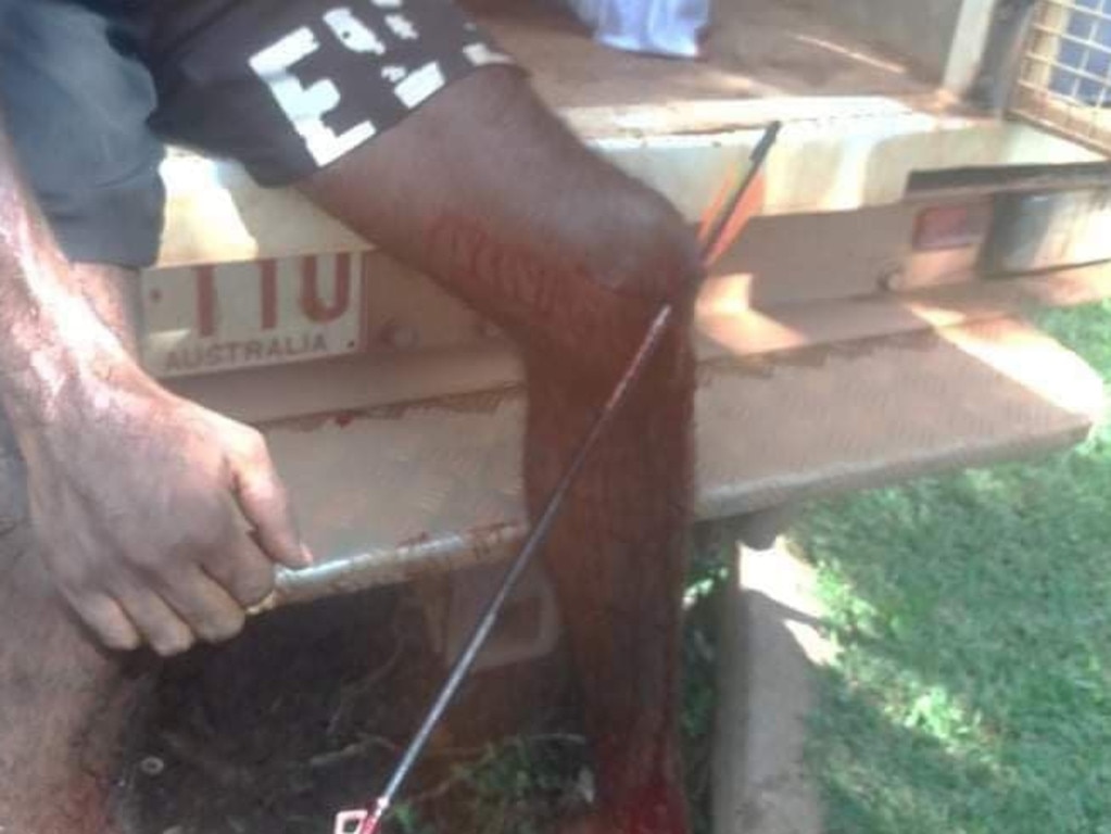 Image of a man impaled by an arrow following a recent skirmish in Wadeye.