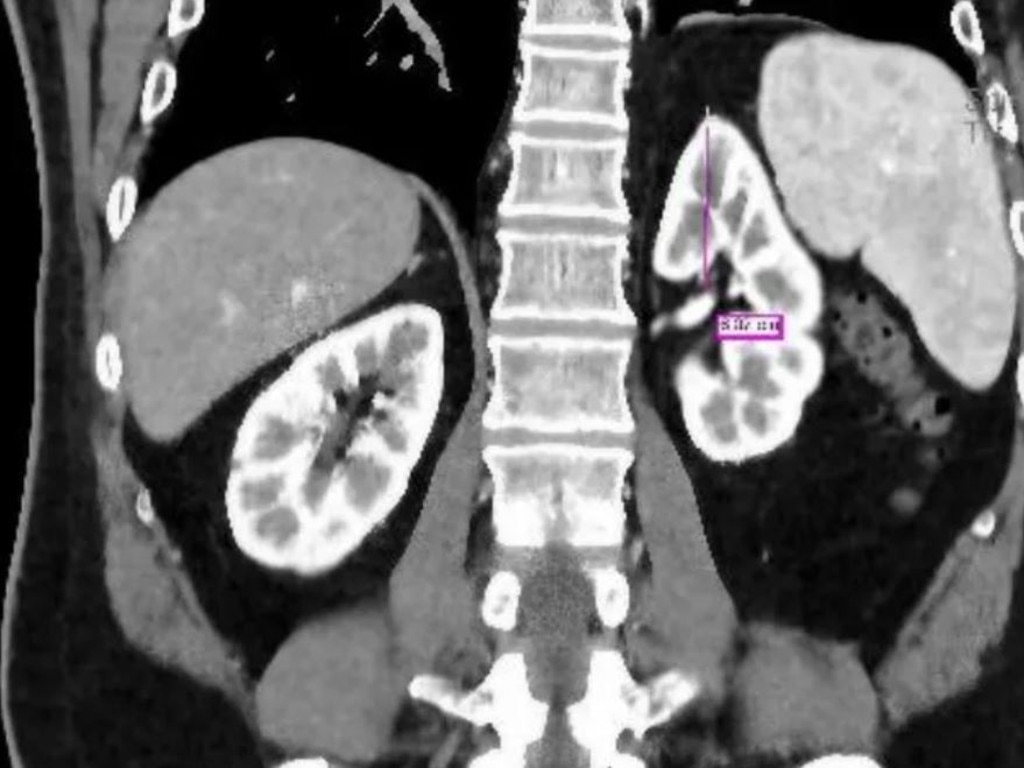 Cheng's right kidney appears 'pushed down'.