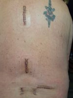 Four wires between 35-70cm long have been inserted in Colin Anderson’s spine, along with a battery powered device to help minimise his nerve pain.