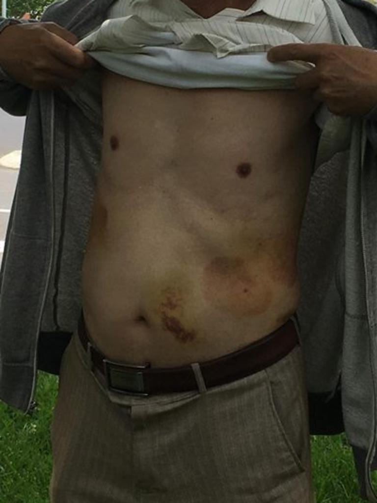 The 74-year-old Donvale victim shows his bruised body nine days after he was attacked.