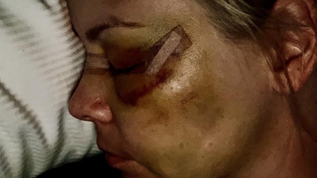 Kimbarlie O'Reilly suffered horrendous injuries after being bashed by Jake Frecker, who ordered her to lie about the incident when police arrived. Picture: Supplied